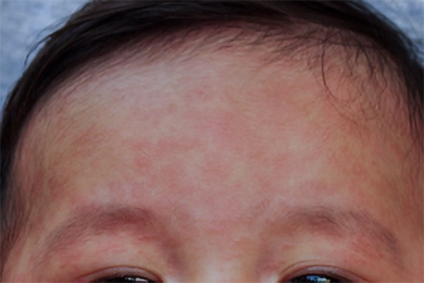 measles on face
