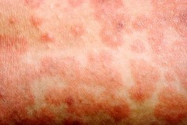 measles rash