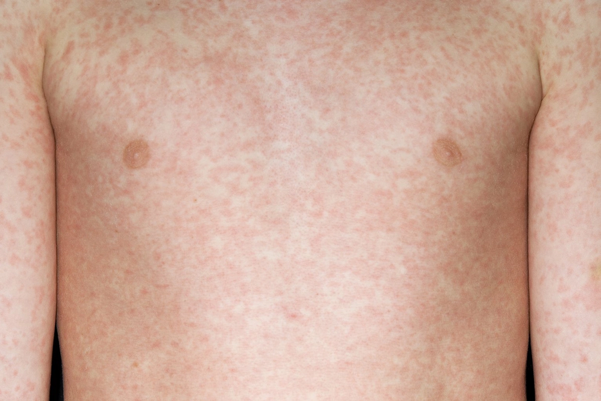 measles torso
